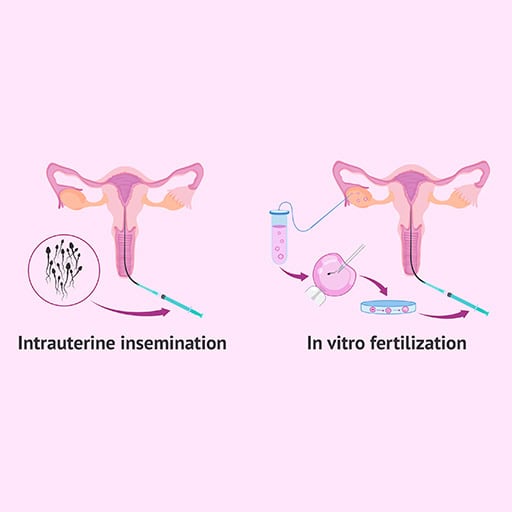Illustration of intrauterine insemination and in vitro fertilization procedures.