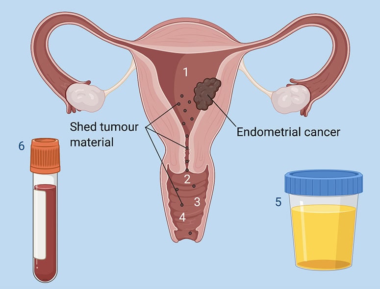 Illustration of endometrial cancer and related uterine conditions.