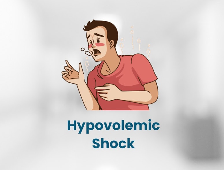 Illustration of a man experiencing hypovolemic shock with symptoms.