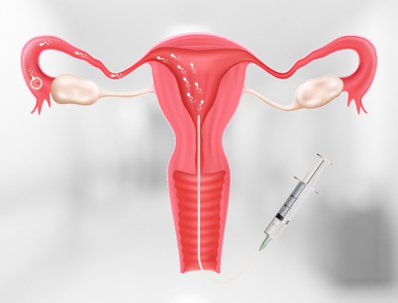Illustration of female reproductive system with syringe for Gynae Procedures.
