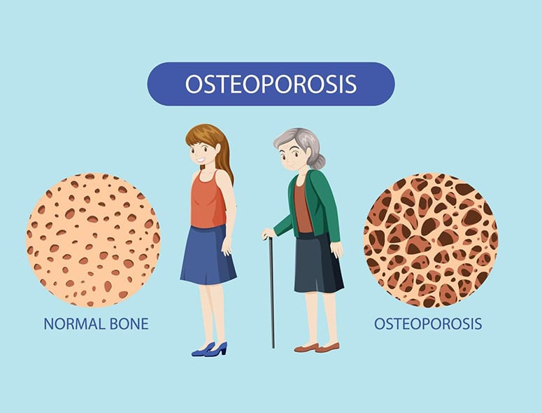 Comparison of normal bone and osteoporosis-affected bone.