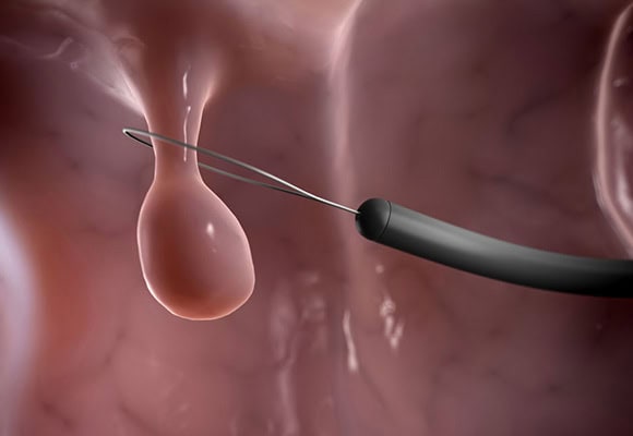Medical instrument performing a fertility procedure inside the reproductive system.