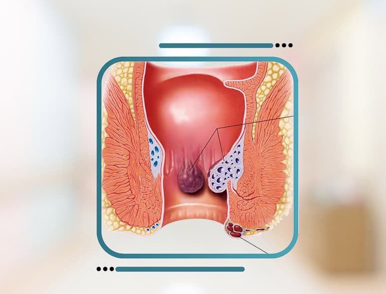 Detailed illustration of rectal bleeding and hemorrhoids in the anal canal.