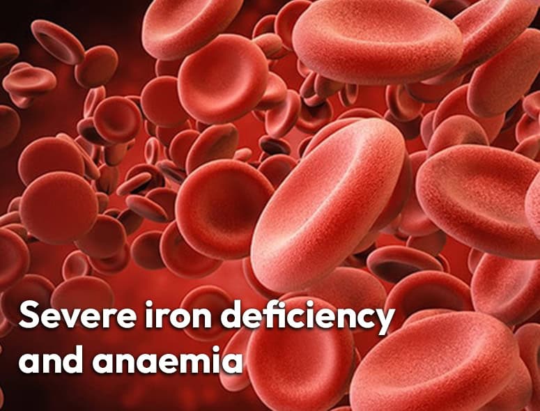 Illustration of red blood cells indicating severe iron deficiency and anemia.