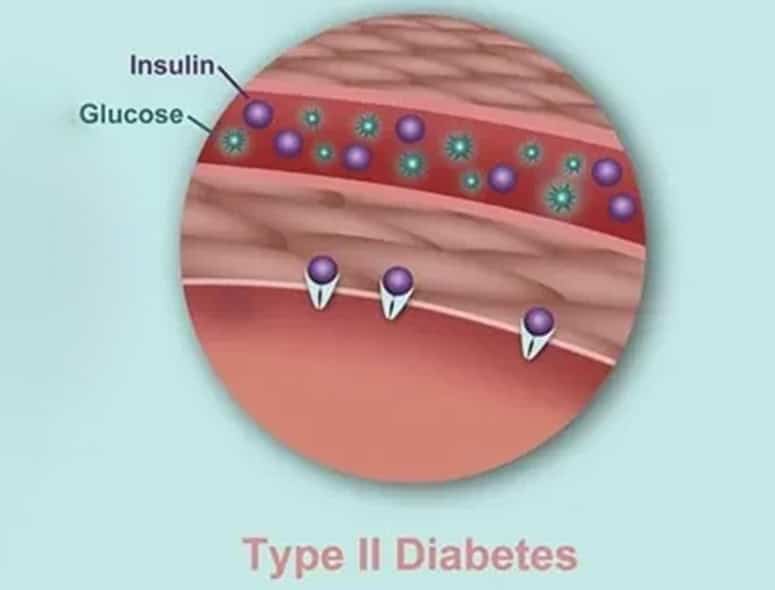 Illustration of Type II Diabetes showing insulin and glucose interaction.