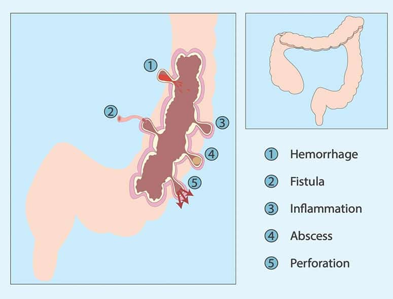 Diagram of intestinal tuberculosis showing hemorrhage, fistula, inflammation, abscess, and perfora.