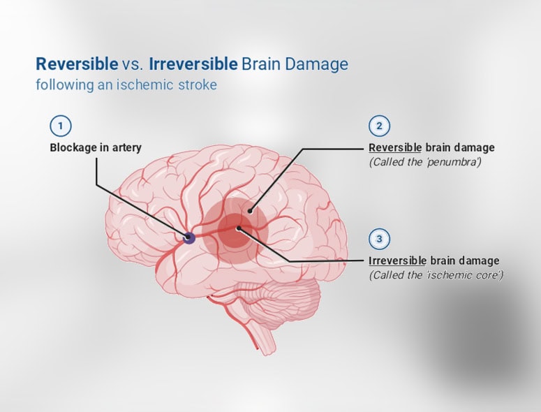 Diagram showing reversible and irreversible brain damage after stroke.