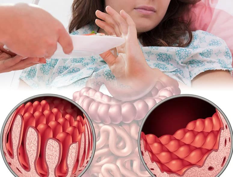 Medical illustration of intestinal tuberculosis affecting the gut lining.