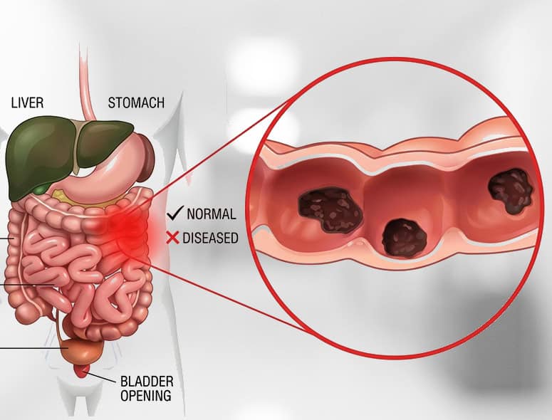 Illustration of intestinal tuberculosis affecting the digestive tract.