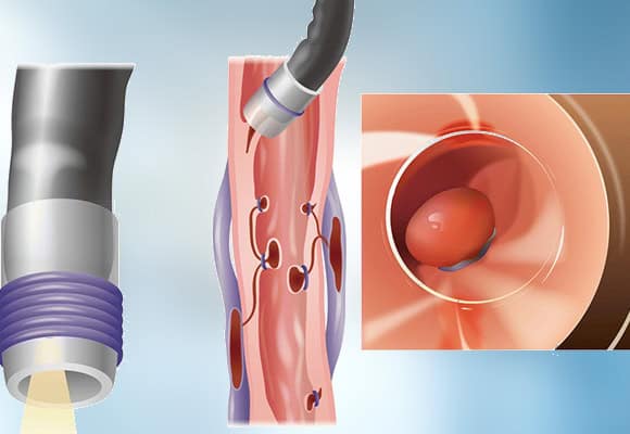 Minimally invasive endoscopic procedure for fertility treatment at Grover Gastro and Fertility.