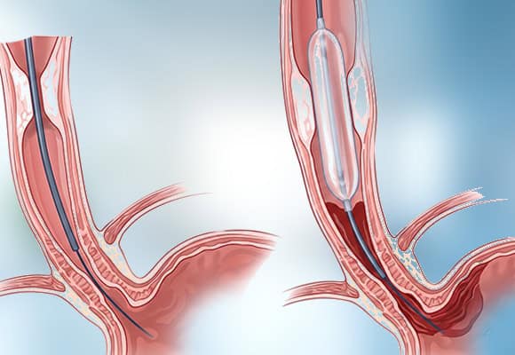 Medical illustration of a minimally invasive endoscopic procedure for gastrointestinal treatment.