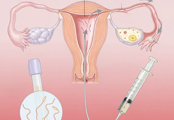 Illustration of female reproductive system with fertility treatment tools.