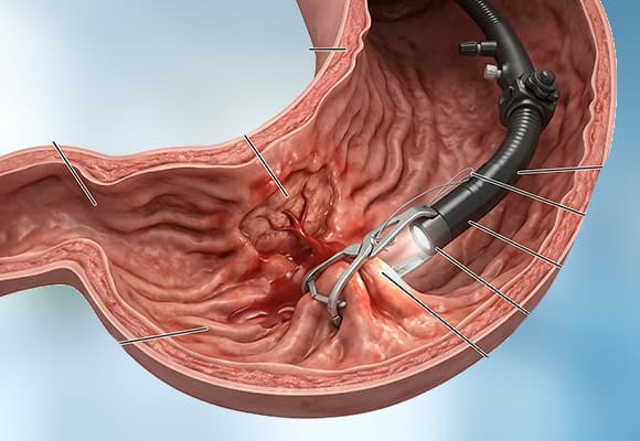Endoscopic view of stomach with surgical instruments for medical procedure.