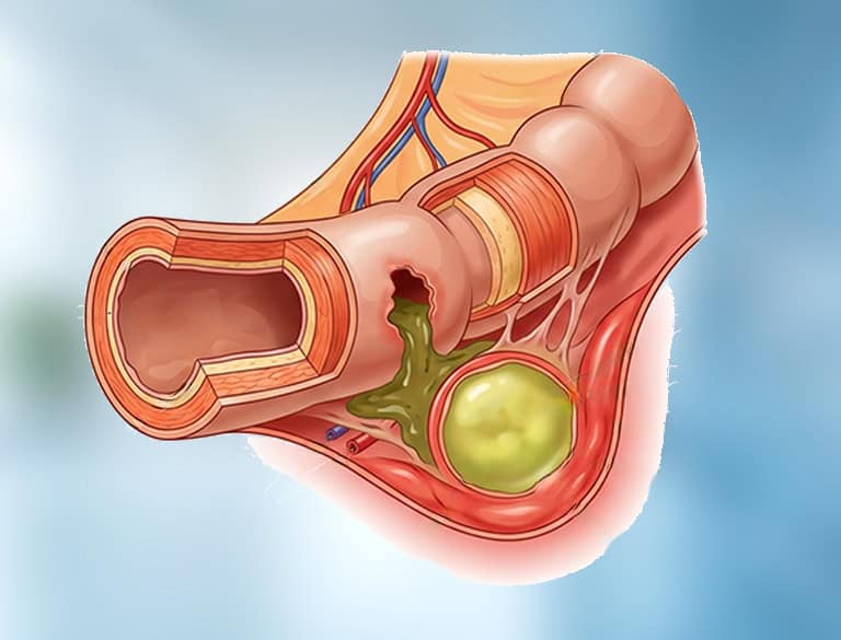 Detailed illustration of an inflamed appendix with pus buildup.