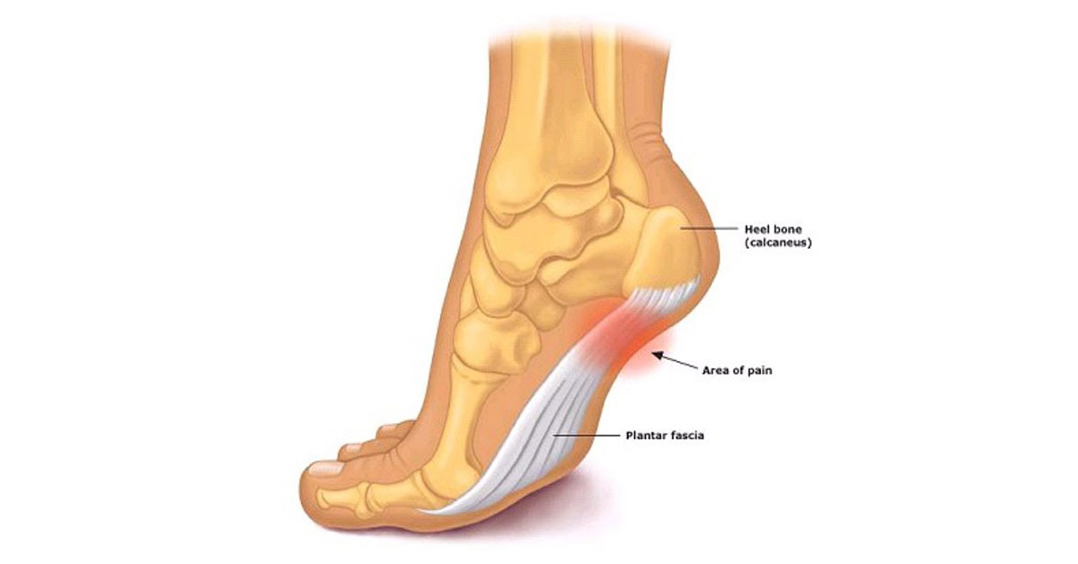 Plantar Fasciitis