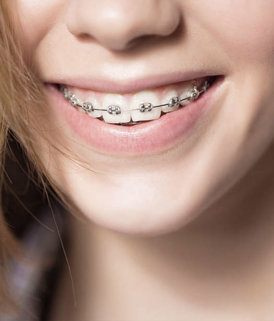 Teenager smiling while wearing braces