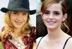 Before and after of Emma Watson comparison showcasing a smile transformation Woodland Hills with braces Woodland Hills. The left shows teen braces Woodland Hills or kids orthodontist Woodland Hills for teeth straightening Woodland Hills, while the right highlights the successful results of orthodontic treatment Woodland Hills for a beautiful smile Woodland Hills.