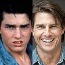 Tom Cruise smile transformation Woodland Hills with orthodontic treatment Woodland Hills. Before and after showing effective teeth straightening Woodland Hills by an expert orthodontist Woodland Hills.