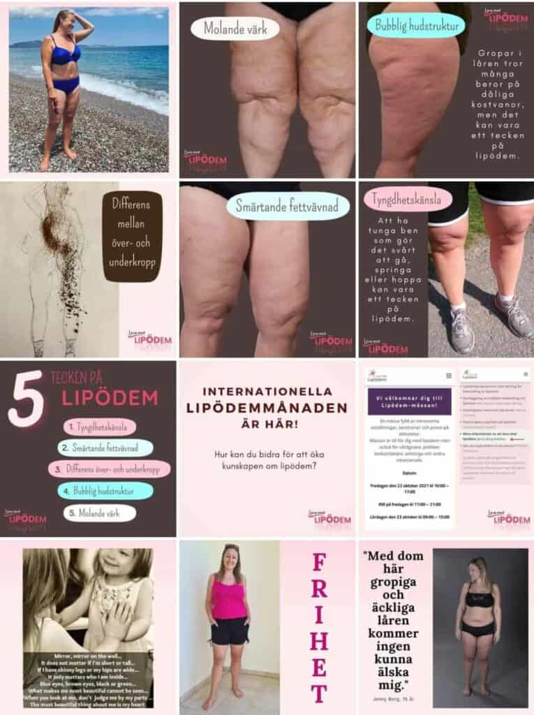 Leva med lipödem