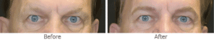 eyebrow-tattoo-patient