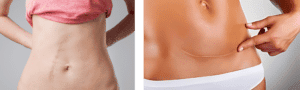 Stretch-marks