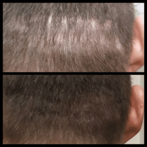 Before and after results of scalp micropigmentation showing scar coverage on the back of the head.