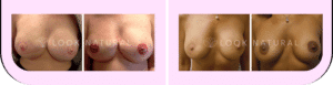 3-D nipple and areola tattooing process diagram showing before and after results