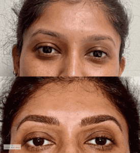 Before and after women’s eyebrow restoration treatment with naturally enhanced brows.