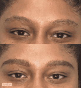 Before and after eyebrow restoration showing transformation from sparse brows to naturally fuller, well-shaped eyebrows.