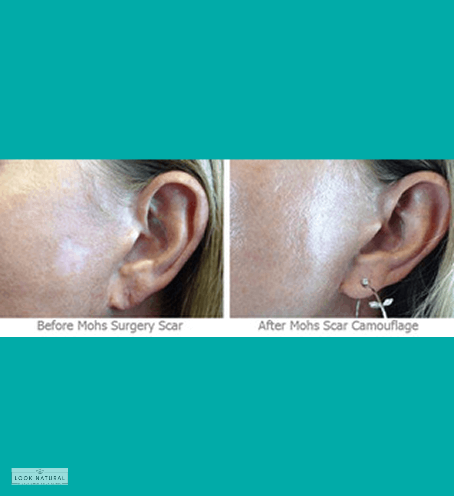 Before and after Mohs surgery scar camouflage treatment near ear