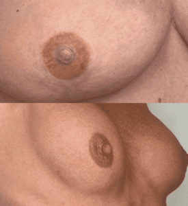 Before and after 3D nipple and areola tattooing for breast reconstruction
