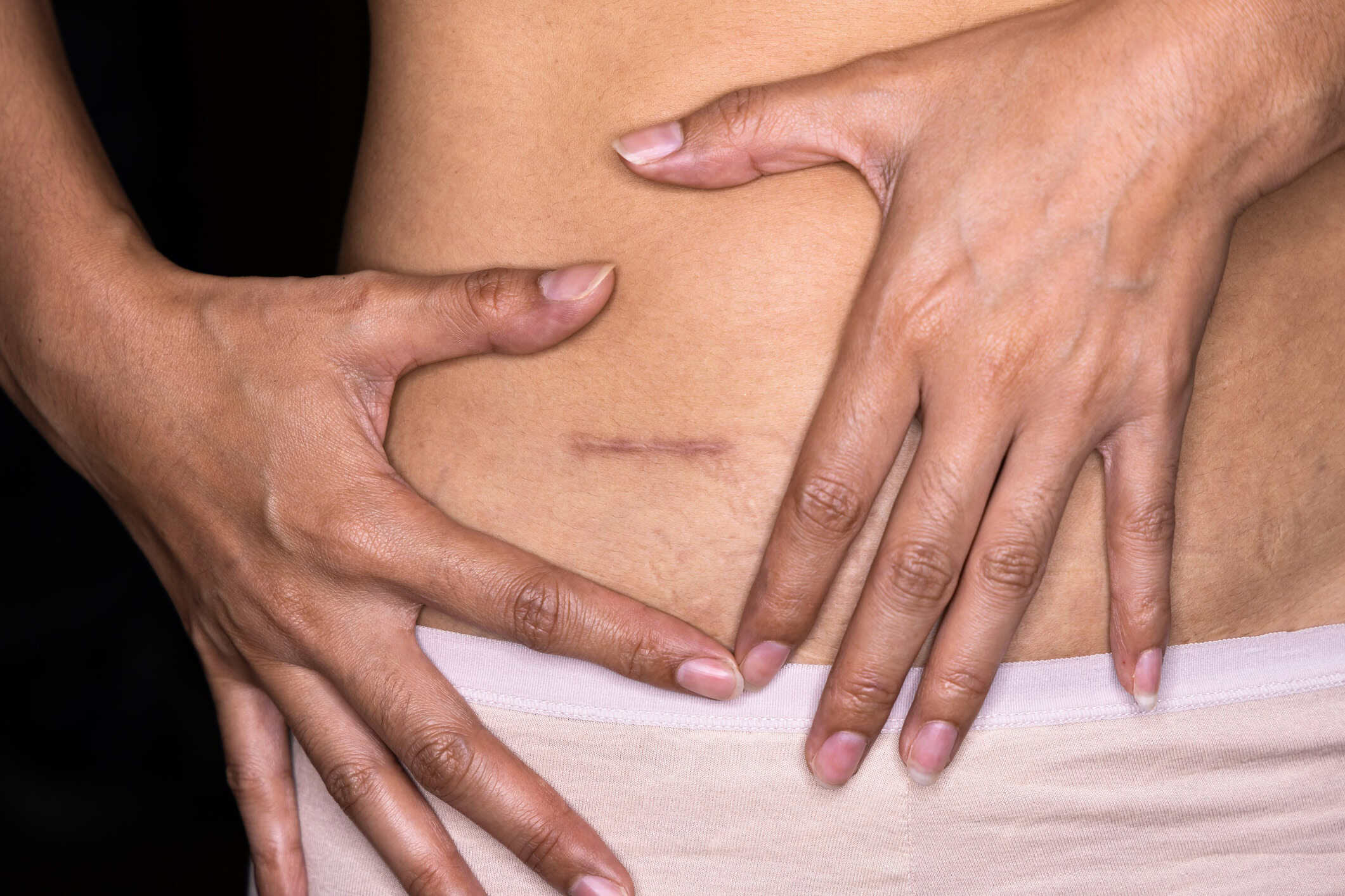 Close-up of a person’s midsection with two hands pinching the abdomen and a small horizontal scar on the skin.
