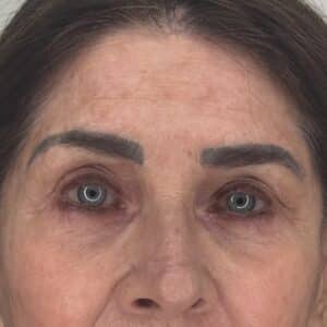 Brow+Corrective+B4+Joan+Ford+26 | Look Natural Atlanta - Micropigmentation Clinic Before Brow Correction Tattoo