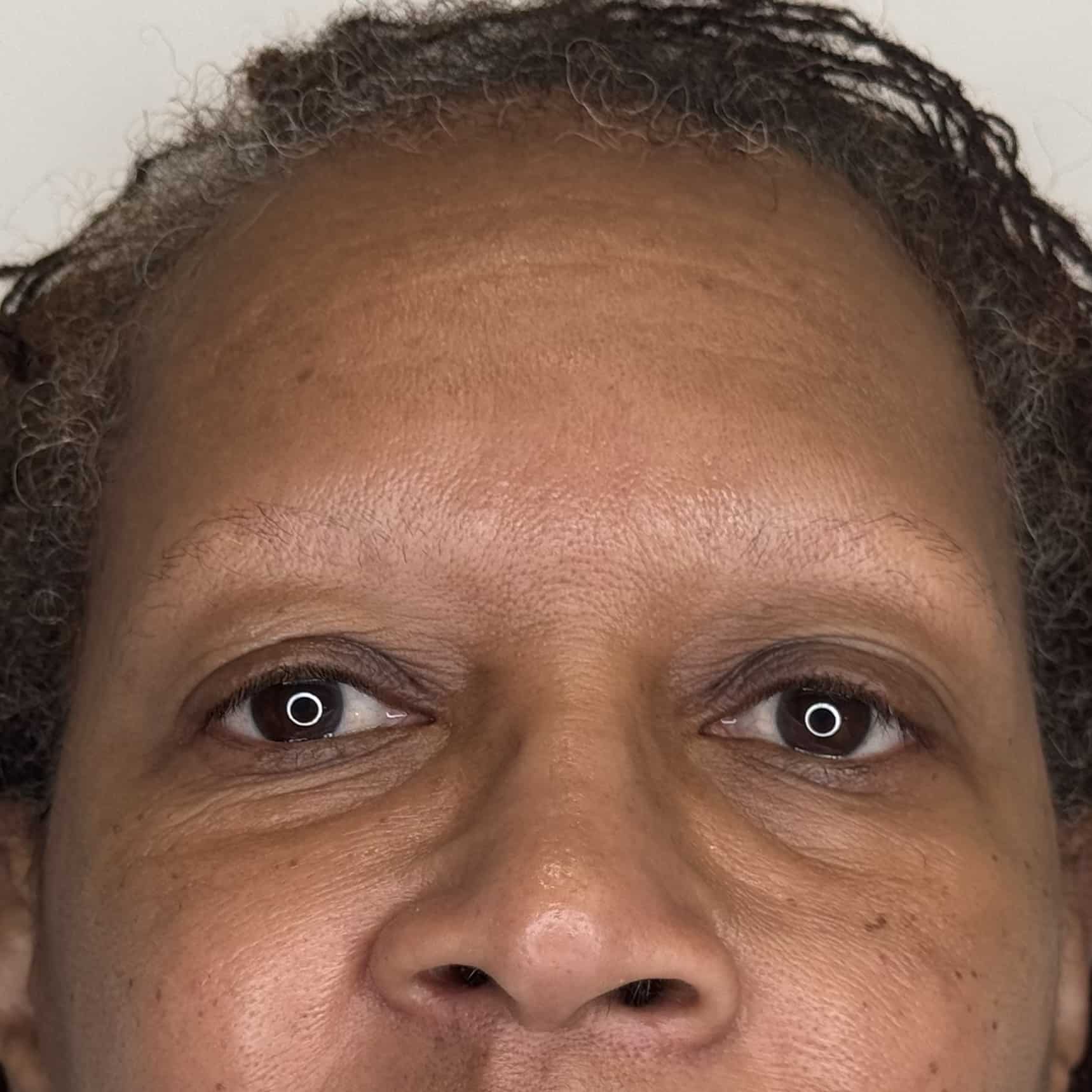 Thyroid Hair Loss