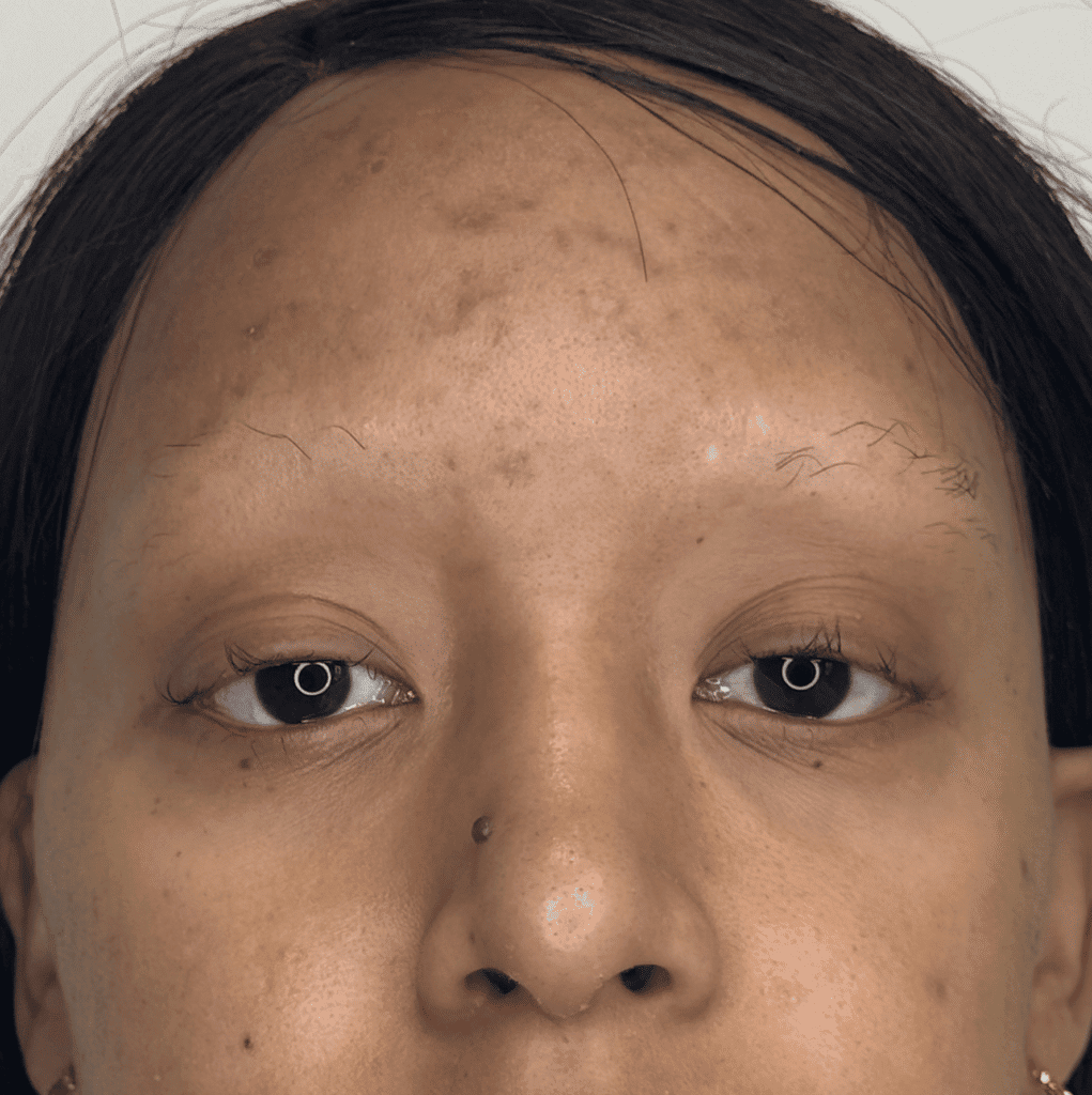 BEFORE PIC Alopecia Hair Loss | Look Natural Atlanta - Micropigmentation Clinic Before Alopecia Hair Loss