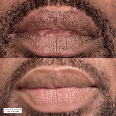 Two close-up photos of a person’s lips with beard stubble shown side-by-side, depicting before and after lip treatment, with a small Look Natural watermark in the corner.