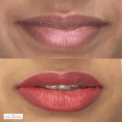 Close-up of lips: natural-looking upper lip and bold red lipstick on the lower lip, with braces visible between the teeth.