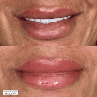 Close-up of a smile showing natural lips above and fuller, glossy lips after enhancement below, indicating cosmetic lip augmentation results.