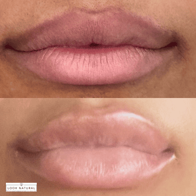 Close-up of lips before (top) and after (bottom) lip enhancement, showing fuller, smoother lips.