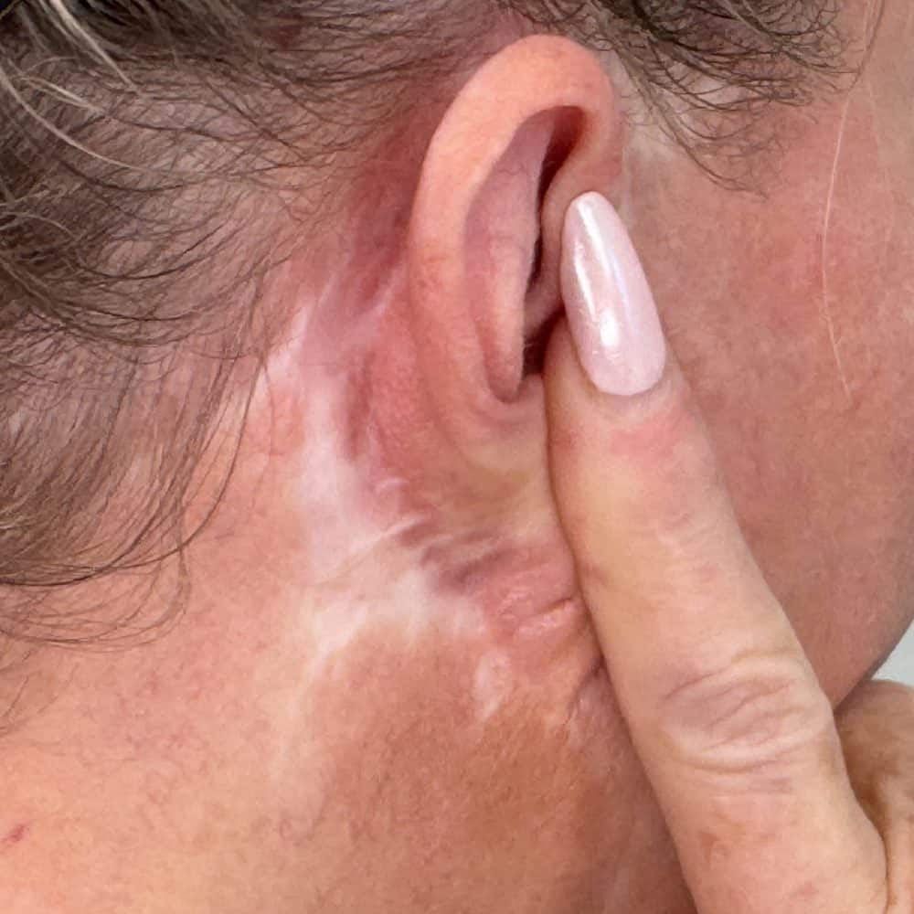Visible facelift scar behind ear before paramedical scar camouflage treatment