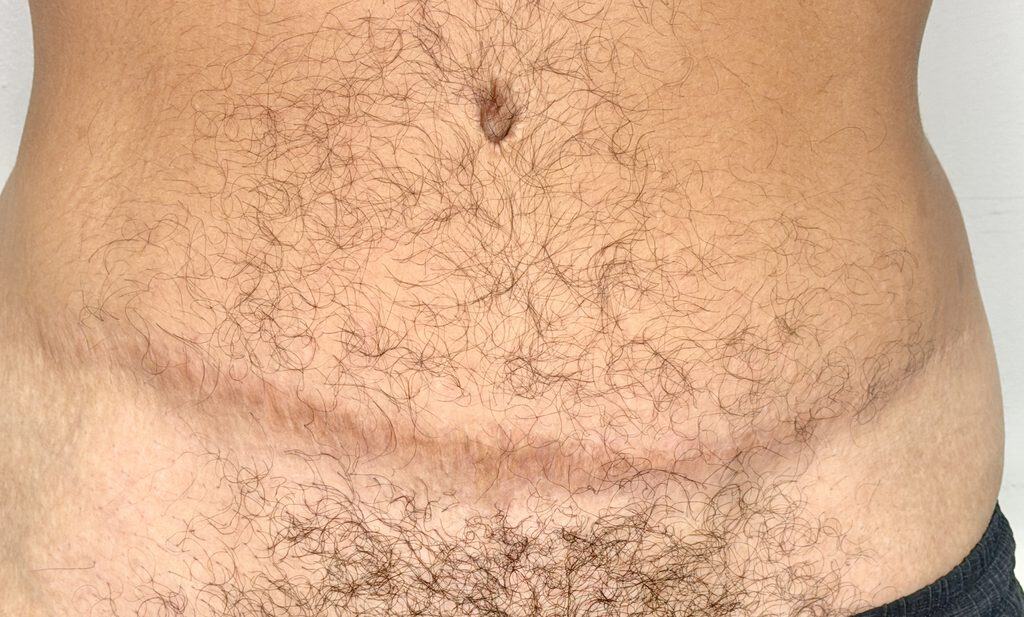 Tummy tuck scar after 2 sessions of scar camouflage, front view, Look Natural Micropigmentation Atlanta.