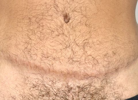 Before and after two sessions of tummy tuck scar camouflage, Look Natural Micropigmentation Atlanta.