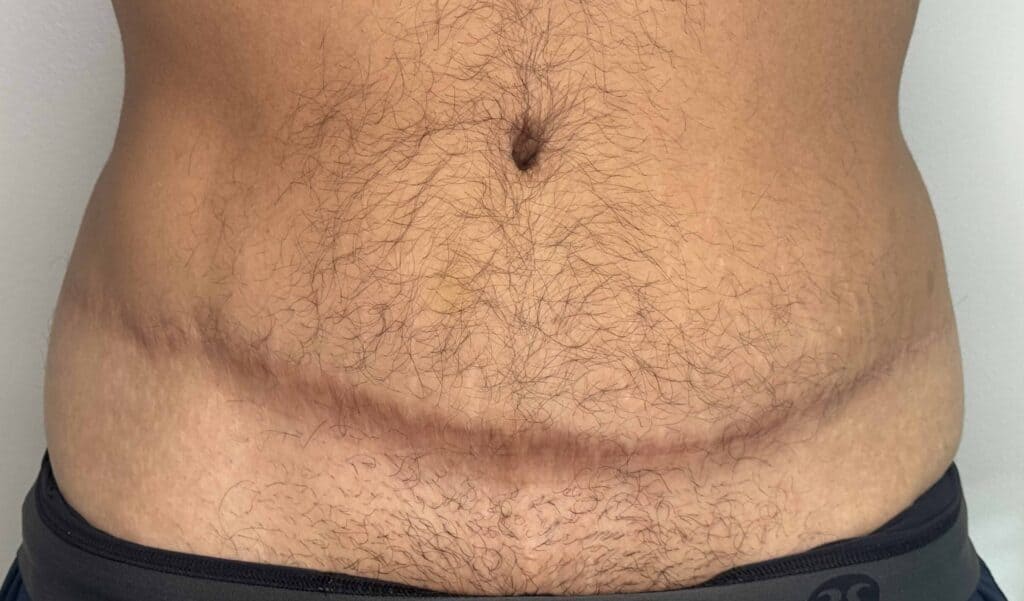 Tummy tuck scar before scar camouflage, front view, Look Natural Micropigmentation Atlanta.
