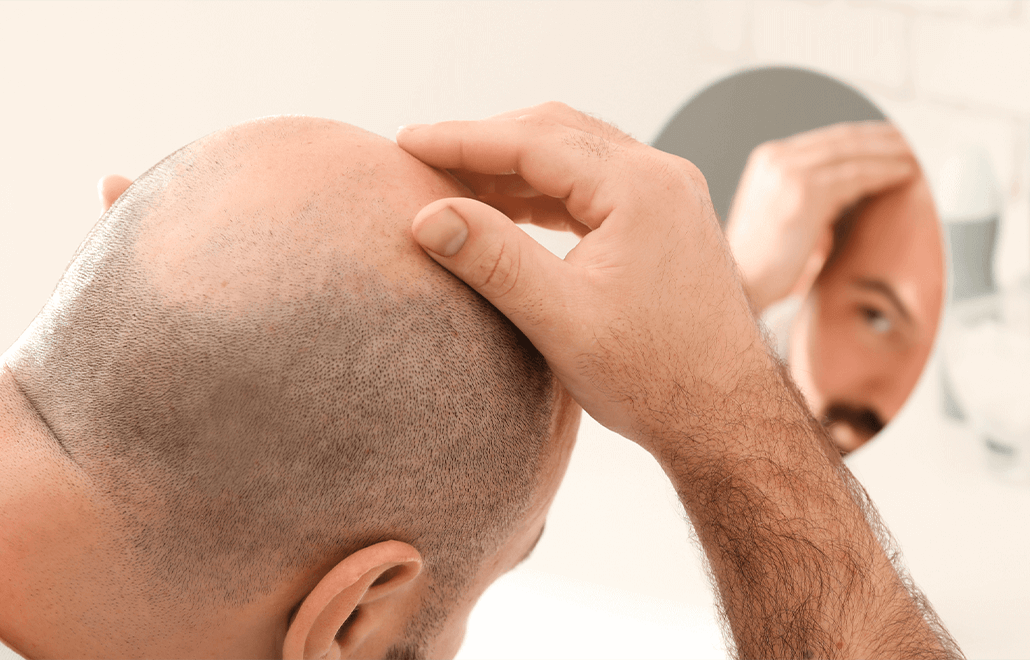 PRP, hair replacement, healthy hair