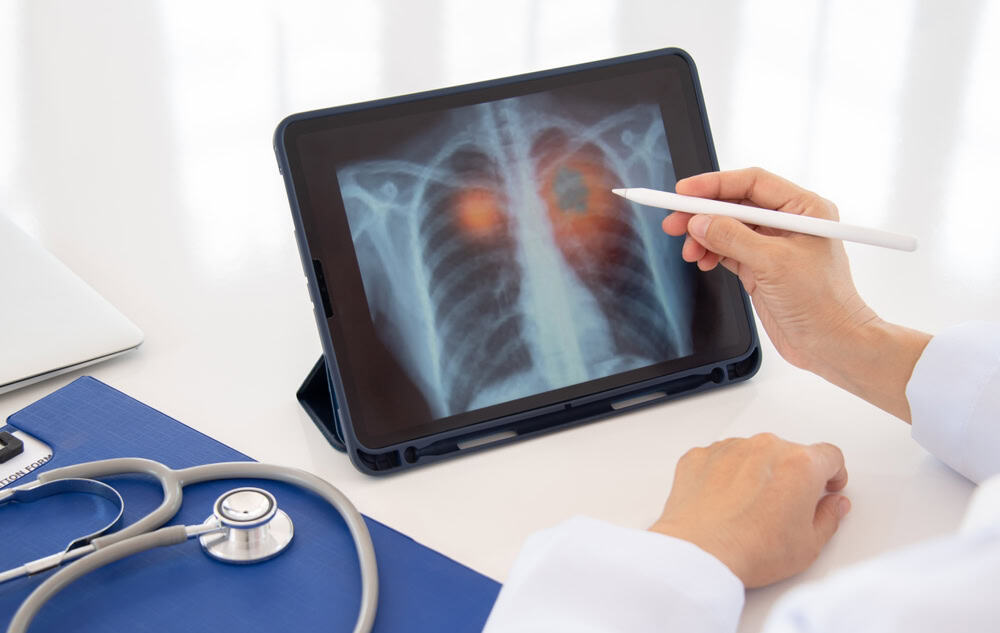 A doctor analyzes a chest X-ray on a tablet, highlighting potential issues with a stylus.
