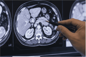 Incidental Pancreatic Cysts: What Your CT Scan Means and When to See a Surgical Oncologist
