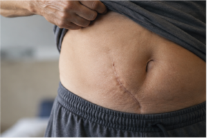 Recurrent and Complex Hernias: Why Previous Repairs Fail and How Robotic Reconstruction Works