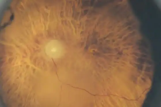 Close-up of a human retina showing blood vessels and optic disc with detailed vascular structure.