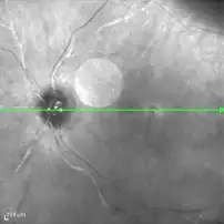High-resolution retinal image showing laser scan line and optic disc with detailed blood vessels and nerve fibers.