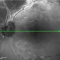 Detailed image of retinal blood vessels captured during fluorescein angiography, showing the vascular structure and blood flow in the retina.